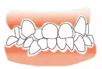 珠海鼎植口腔牙齿拥挤