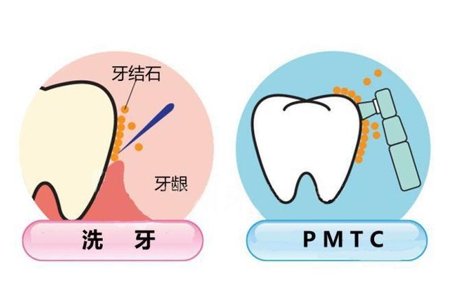 珠海口腔医院PMTC