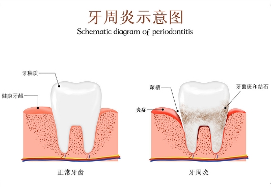 珠海鼎植口腔牙周炎