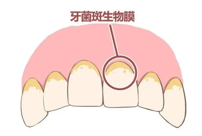 珠海鼎植口腔医院牙菌斑