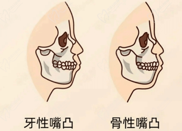 珠海鼎植口腔医院牙齿突出