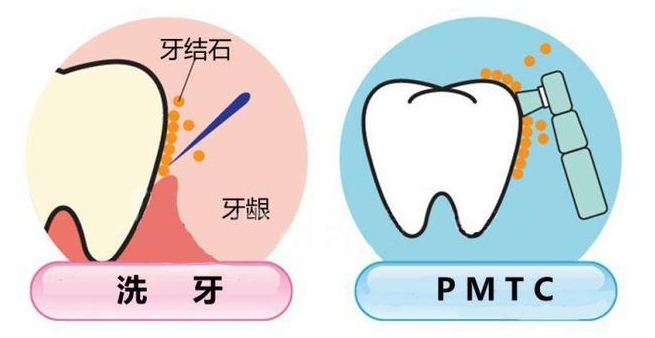 珠海鼎植口腔医院PMTC