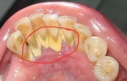 珠海六和口腔医院牙结石